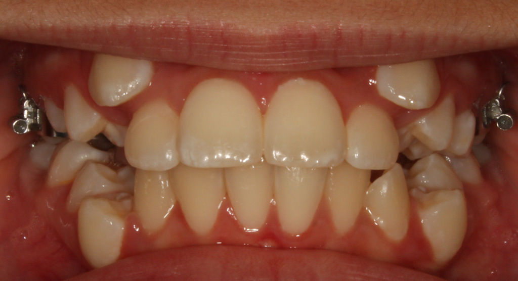 Isabel Zarate Before