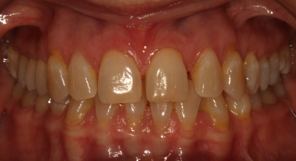 Rebekah Mitchell Before