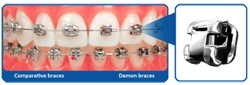 Mckinney Orthodontics Braces